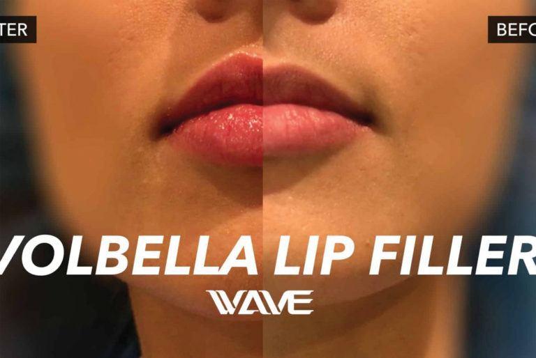 Volbella Lip Filler Blog post Image