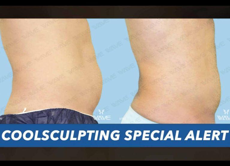 CoolSculpting Special Alert Image