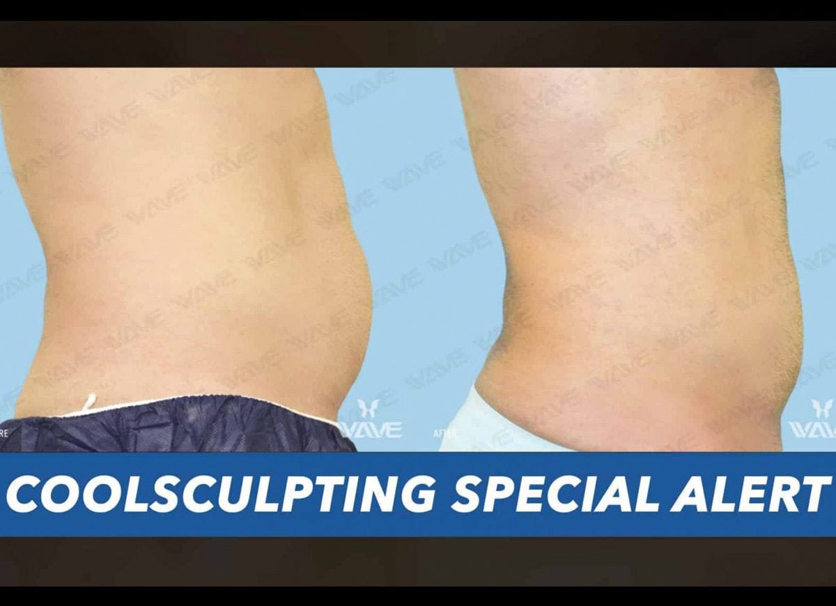 CoolSculpting Special Alert Image