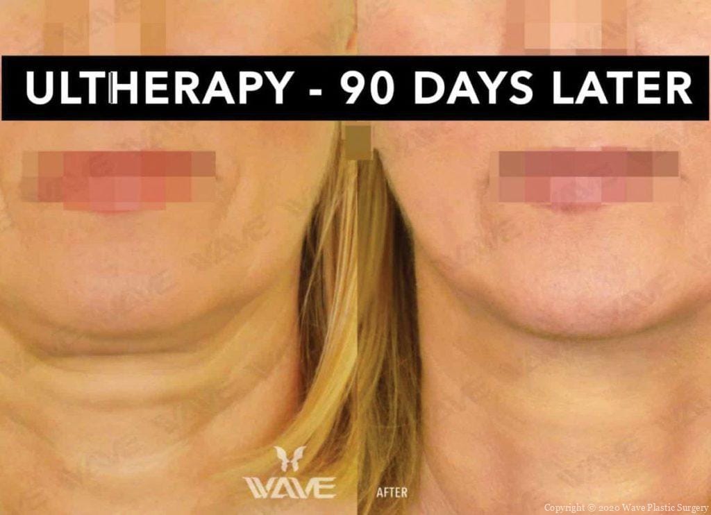 Ultherapy 90 Days Later Wave Blog Banner