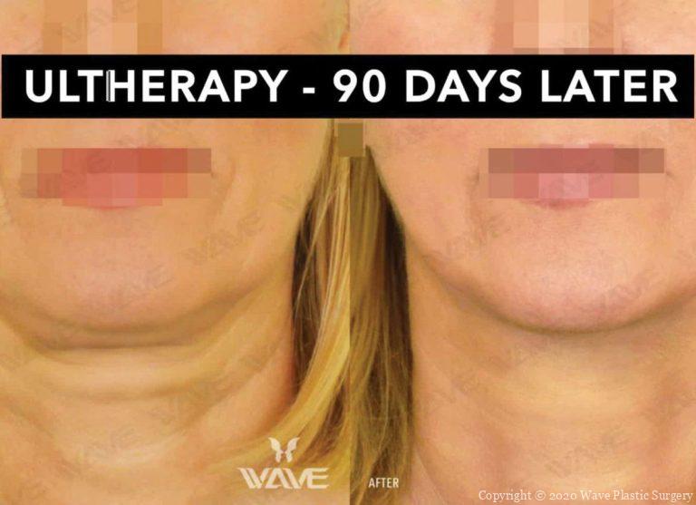 Ultherapy 90 Days Later Wave Blog Banner