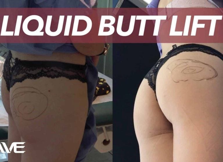 A Liquid Buttlift Blog Post Image