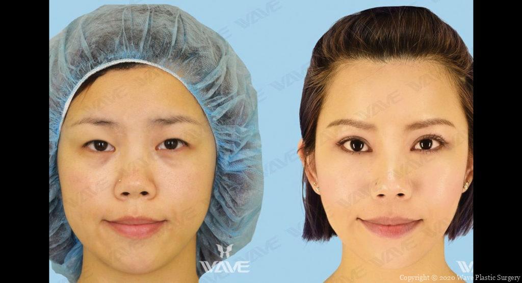 Jenny Upper Bleph Aftercare before after photo for blog featured image