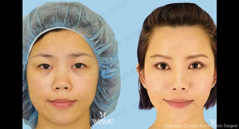 Upper Blepharoplasty Aftercare & Recovery Tips | Wave