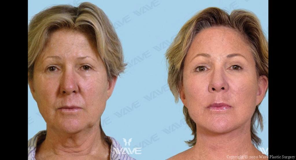 Kim before and After Blog Post Photo