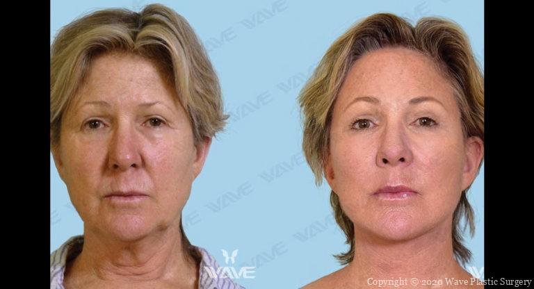 Kim before and After Blog Post Photo