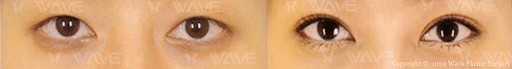 Canthopexy before and after