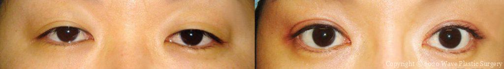 Ptosis Correction before and after