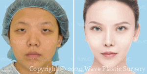 Upper Blepharplasty before and after