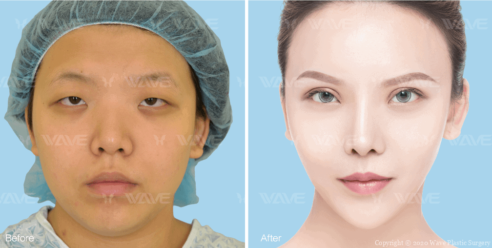 korean eye widening surgery