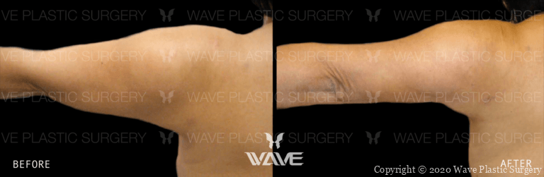Liposuction BA Lipo Website Watermarks 02