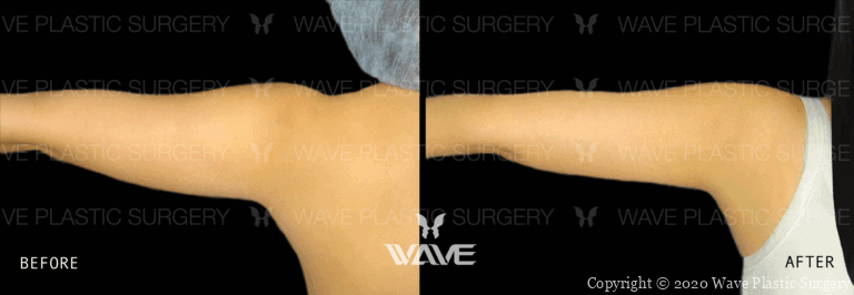 Liposuction BA Lipo Website Watermarks 04