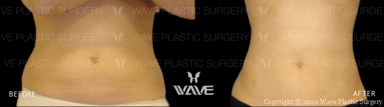 Liposuction BA Lipo Website Watermarks 06