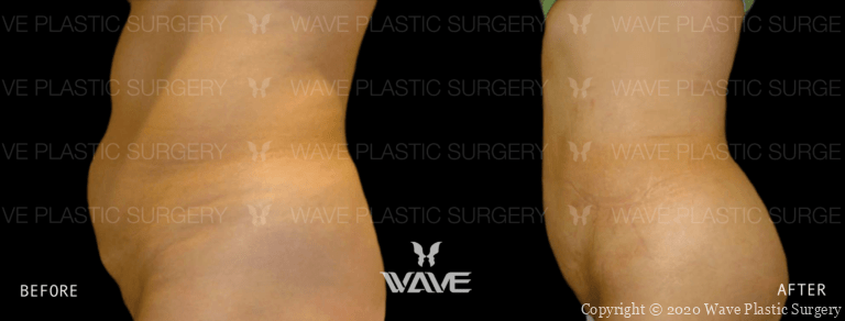 Liposuction BA Lipo Website Watermarks 08