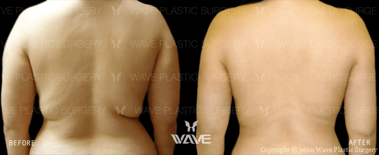 Liposuction BA Lipo Website Watermarks 09