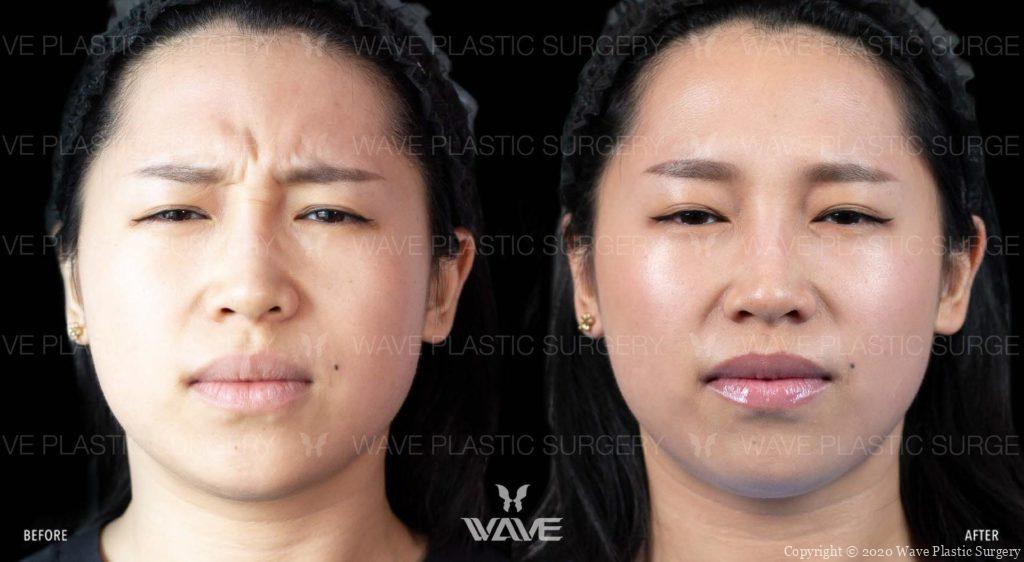 Neuromodulators Botox BA Website Watermark 01 scaled