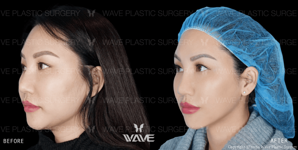 Facetite face and neck tightening before and after results