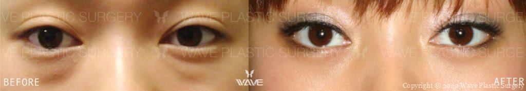 Lower Blepharoplasty Lower Eyelid Surgery