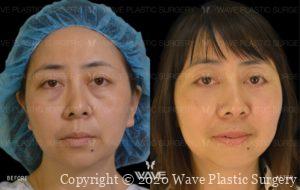 Lower Blepharoplasty Lower Eyelid Surgery