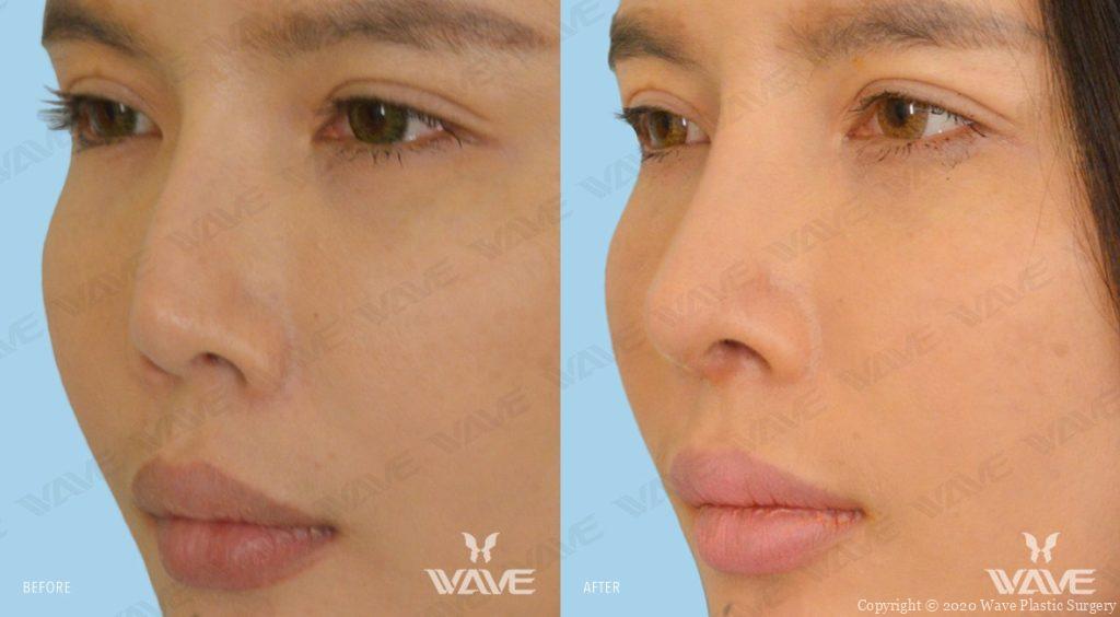 Rhinoplasty Nose Surgery