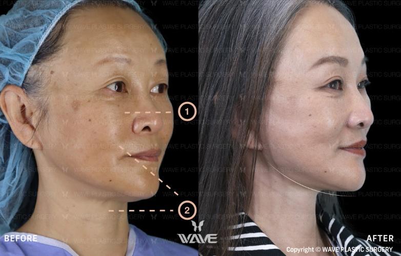 Transformation Gallery Face and Neck Lift 1