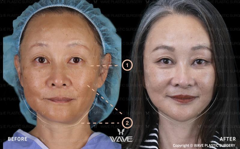 Transformation Gallery Face and Neck Lift 2