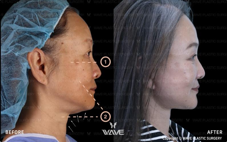 Transformation Gallery Face and Neck Lift 3