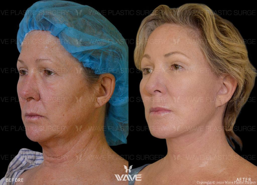 before and after Endoscopic Brow Lift, Wave, Double Pure Fat Crafting, Full Face & Neck Lift