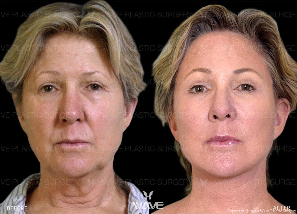 before and after plastic surgery
