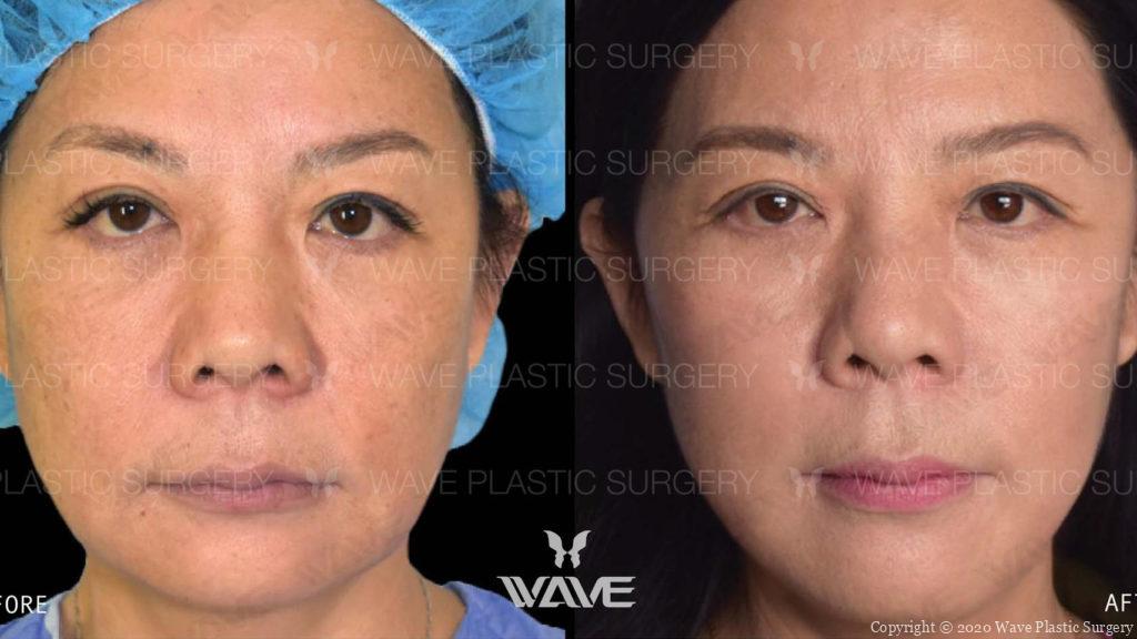 flash lift before and after