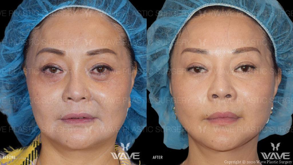 flash lift before and after