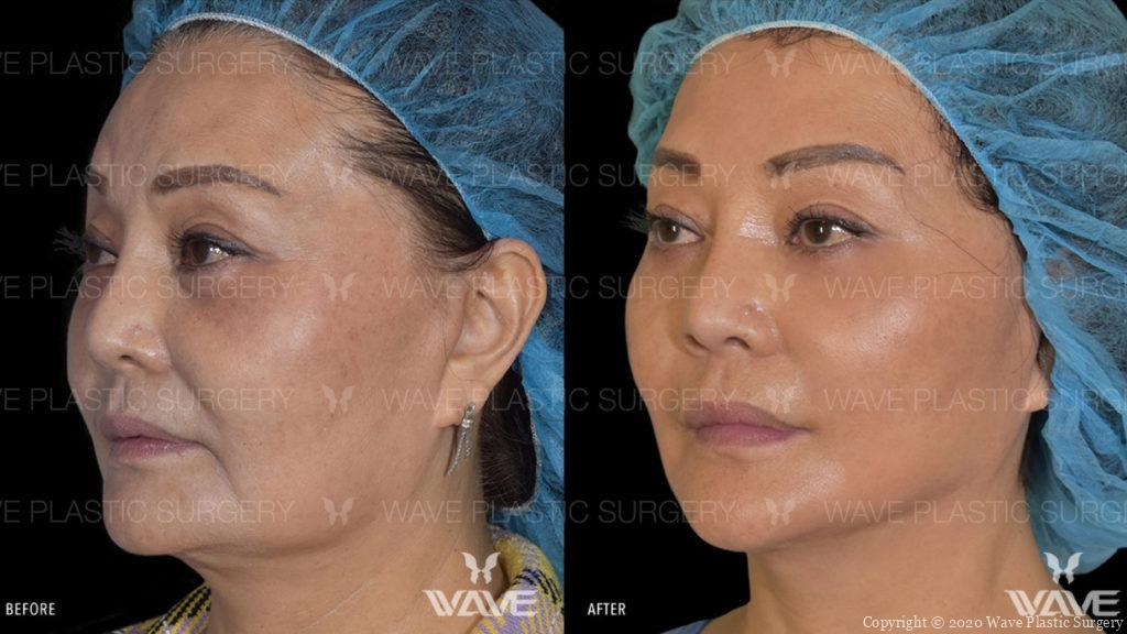 flash lift before and after