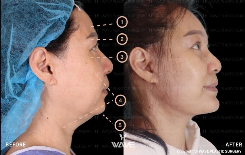 Transformation Gallery Full Face ad Neck Lift 6