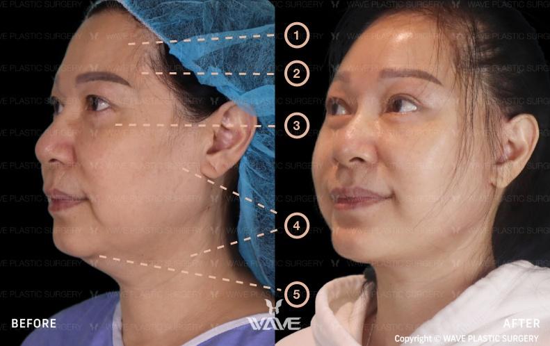 Transformation Gallery Full Face and Neck Lift 4
