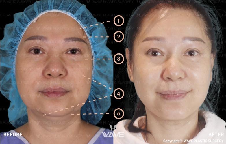 Transformation Gallery Full face and neck Lift 5