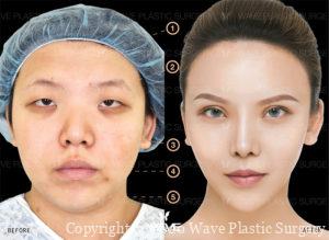 Fat Transfer, Upper Eyelid Surgery, Asian Rhinoplasty, Precision Lift, and Chin Augmentation before and after