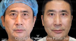 Botox Lower Eyelid Surgery Dermal Filler before and after