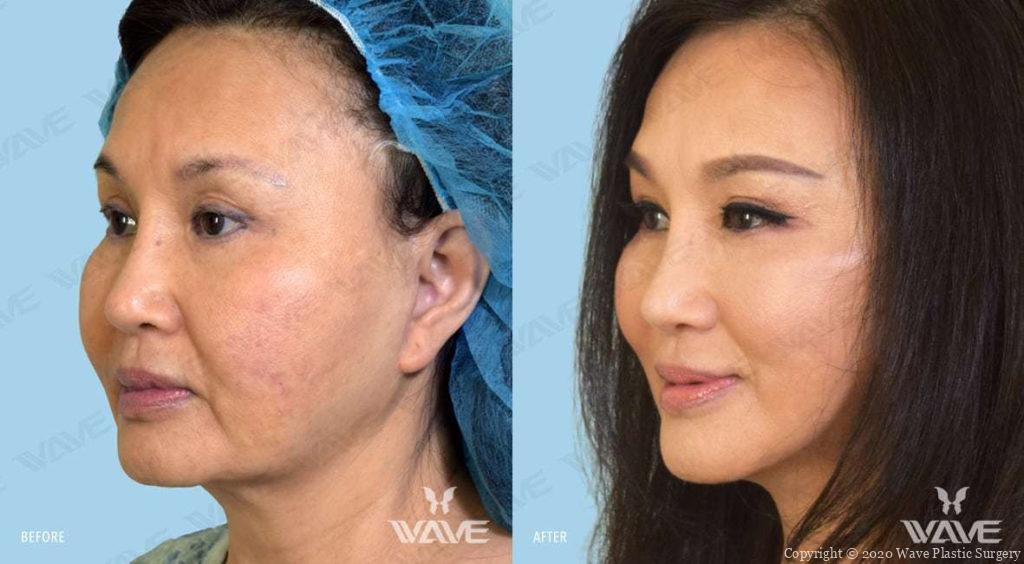 Endoscopic Brow Lift, Aging Eyelid Surgery, and Wave Lift before and after