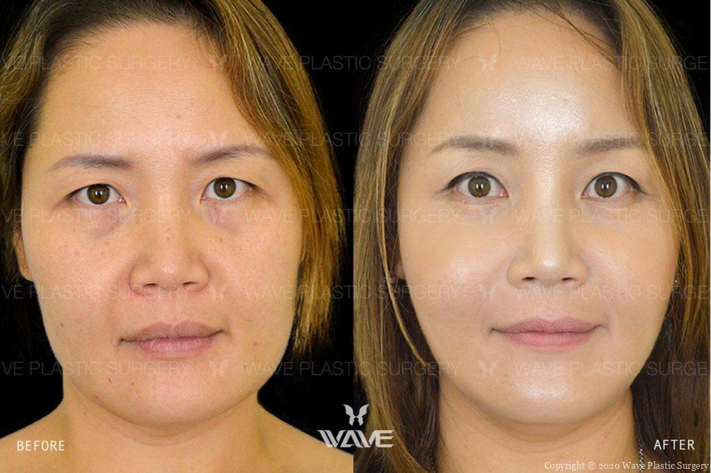 Endoscopic Brow Lift Lower Eyelid Surgery Wave Lift before and after