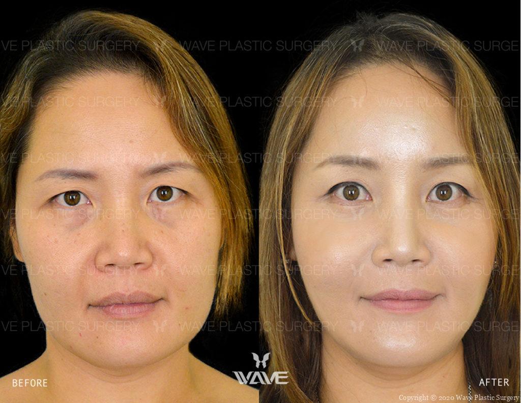 Endoscopic Brow Lift Lower Eyelid Surgery Wave Lift before and after
