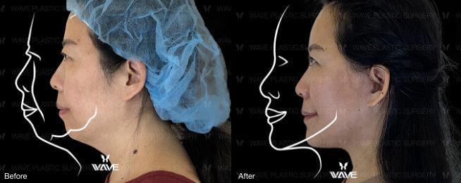 chin augmentation before and after