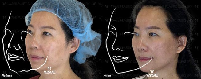 chin augmentation before and after