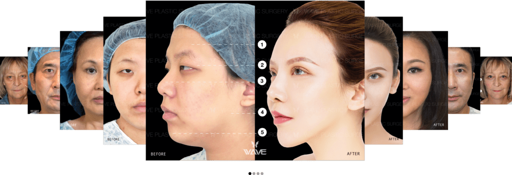 plastic surgery before and after