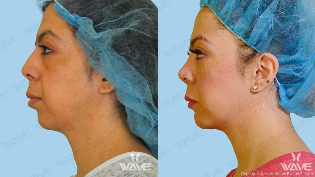 genioplasty chin augmentation before and after
