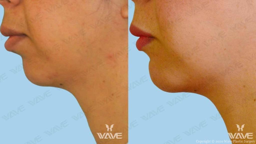 genioplasty chin augmentation before and after