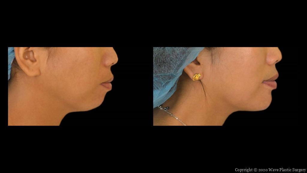 genioplasty chin augmentation before and after