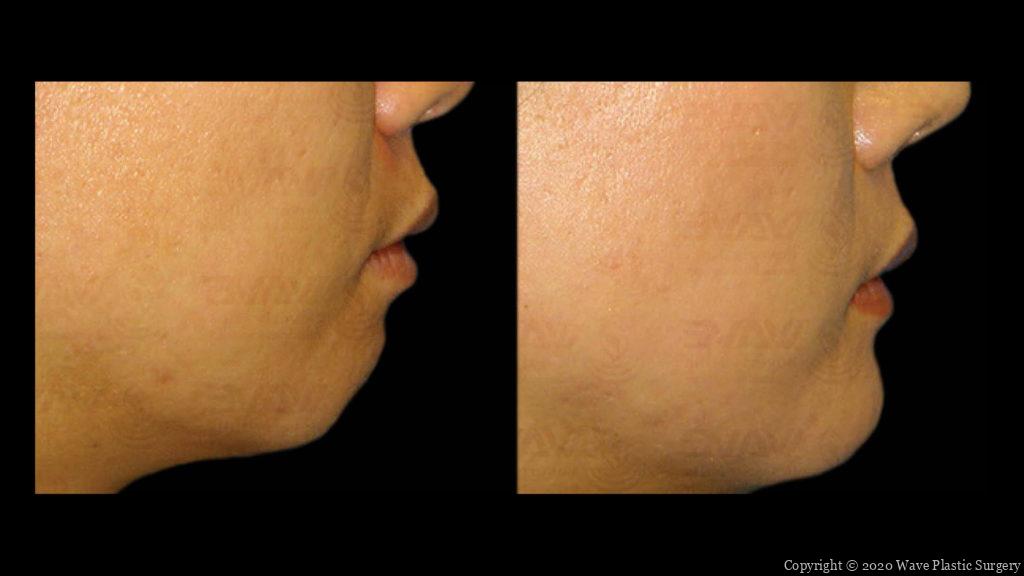 genioplasty chin augmentation before and after