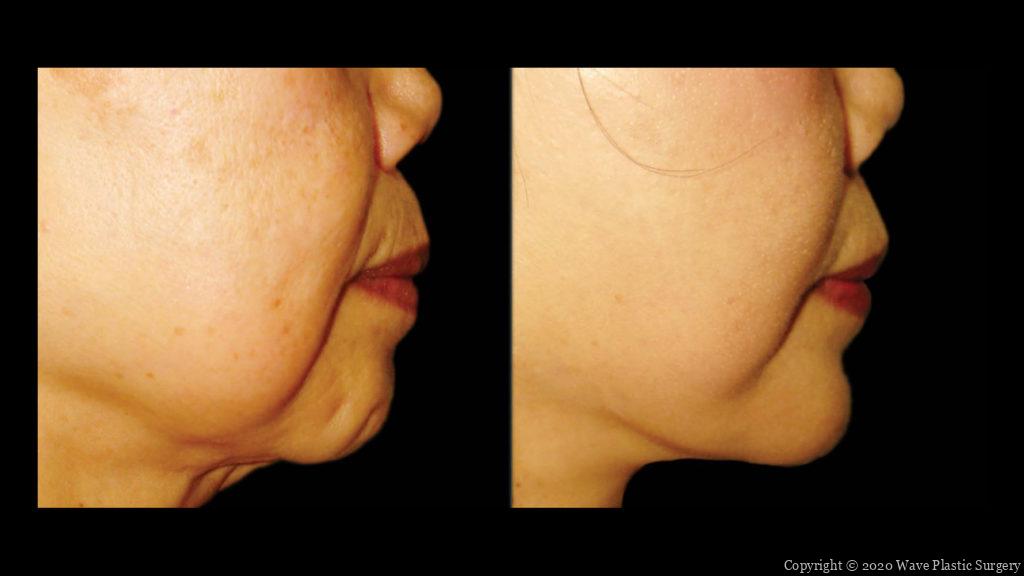 genioplasty chin augmentation before and after