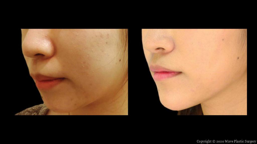 genioplasty chin augmentation before and after