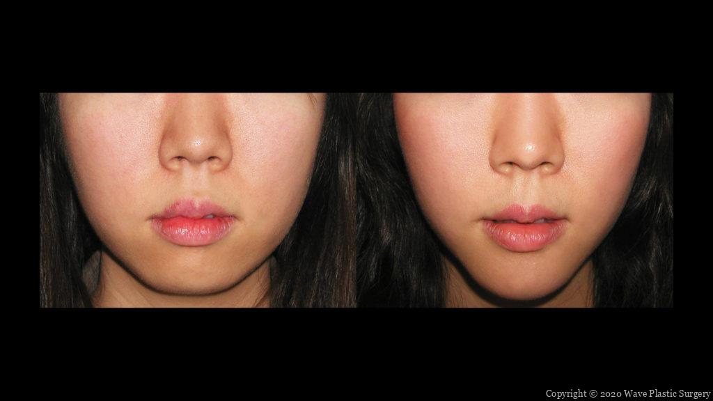 genioplasty chin augmentation before and after